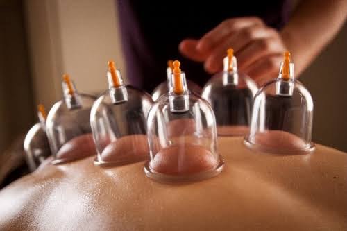 cupping therapy